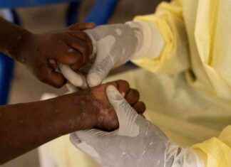 Auswirkungen und Prävention von Mpox in Afrika news-18102024-102940